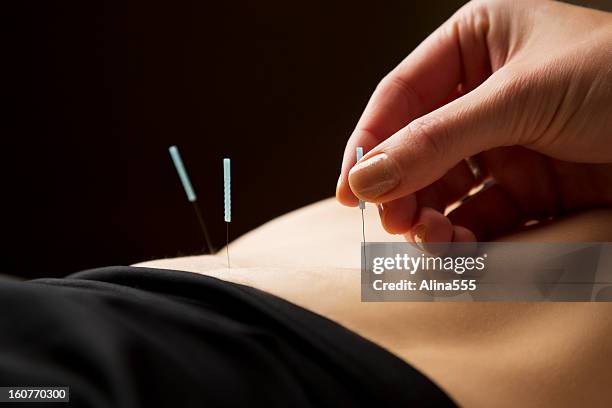 woman getting acupuncture treatment at the spa - accupuncture 個照片及圖片檔