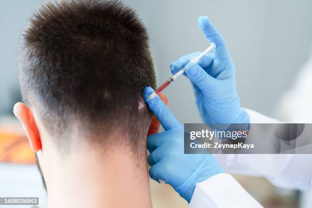 mesotherapy treatment for hair loss - alopecia stockfoto's en -beelden
