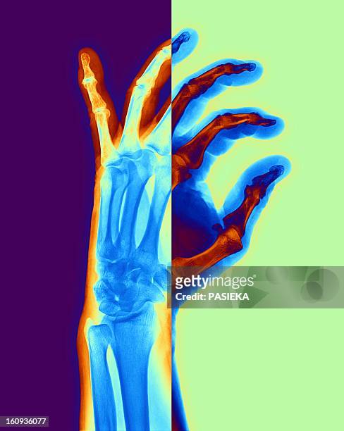 arthritic hand, x-ray - arthritis hands stock-grafiken, -clipart, -cartoons und -symbole