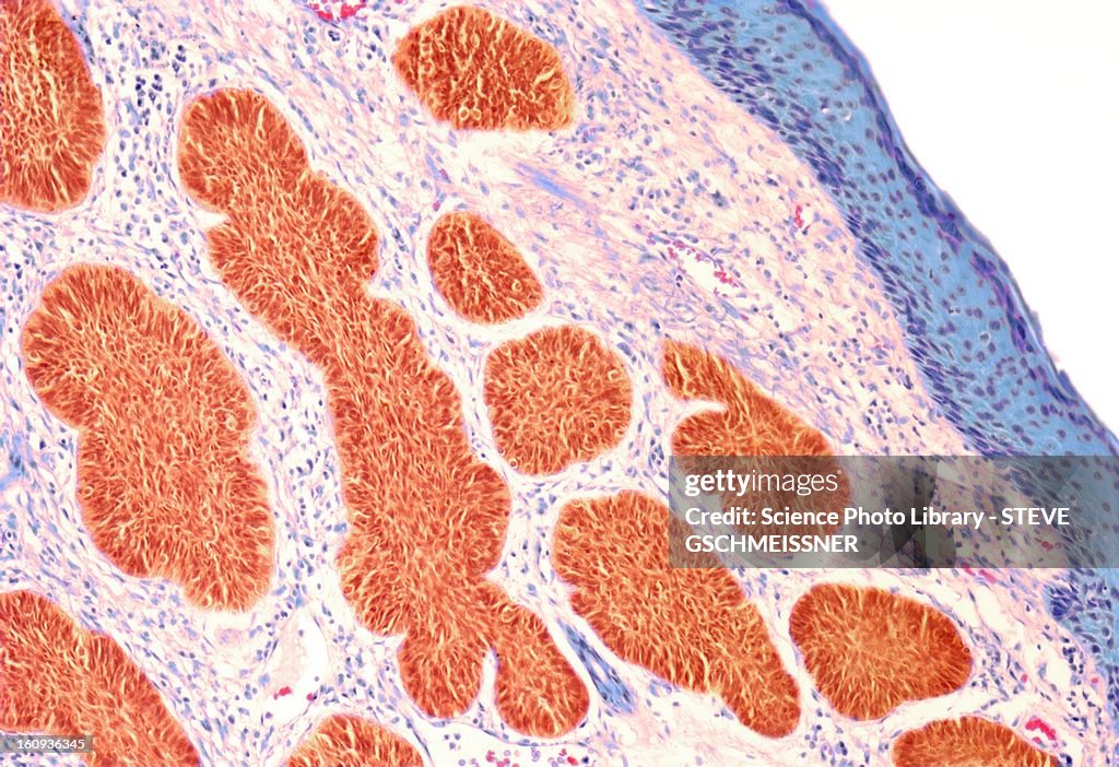 Skin cancer, light micrograph