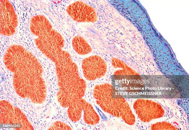 skin cancer, light micrograph - rodent stock illustrations