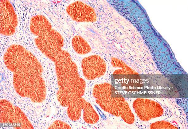 skin cancer, light micrograph - animal skin 幅插畫檔、美工圖案、卡通及圖標