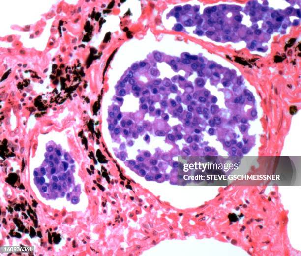 secondary lung cancer, light micrograph - lung cancer stock illustrations