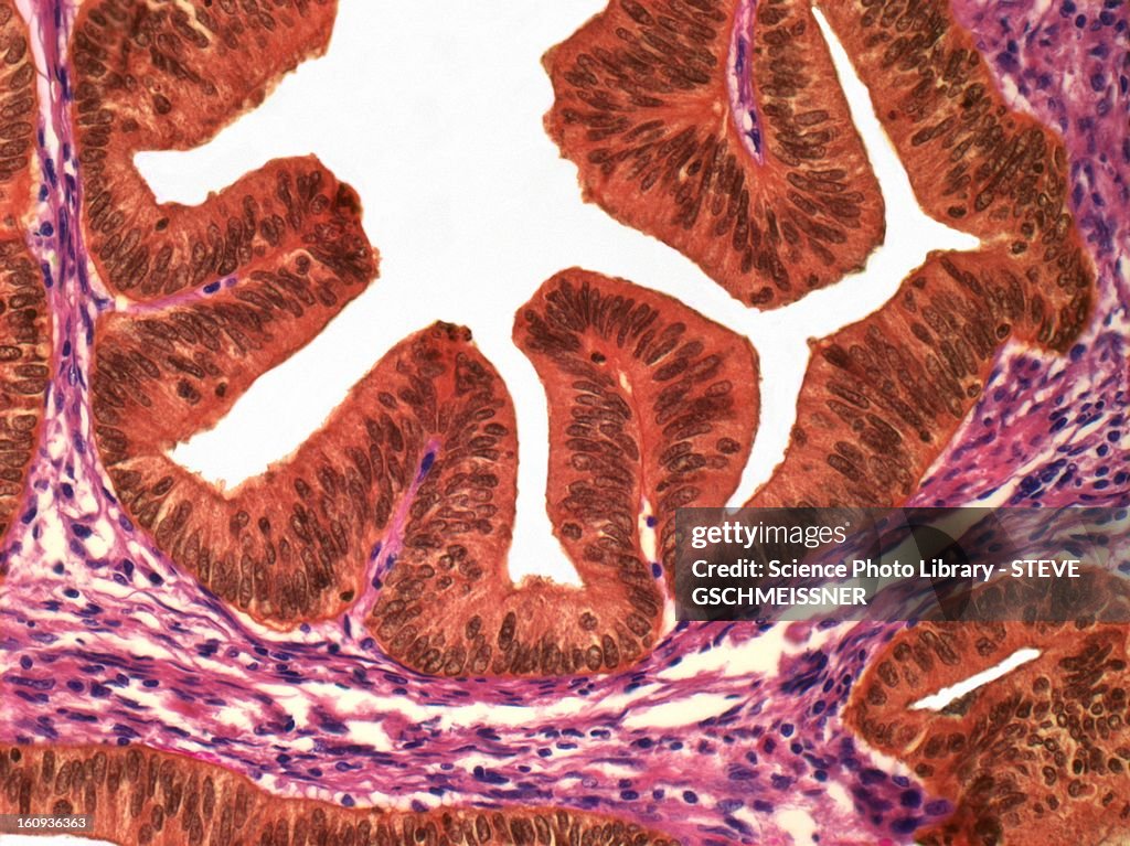Uterine cancer, light micrograph