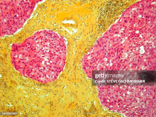 ilustrações, clipart, desenhos animados e ícones de breast cancer, light micrograph - tecido humano termo anatômico