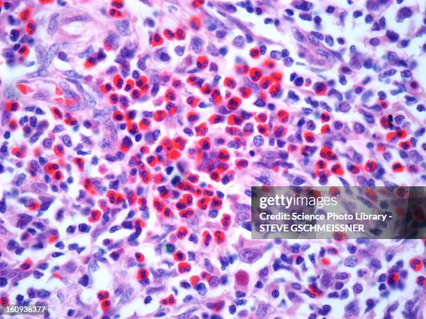 stockillustraties, clipart, cartoons en iconen met hodgkin's lymphoma, light micrograph - eosinophil