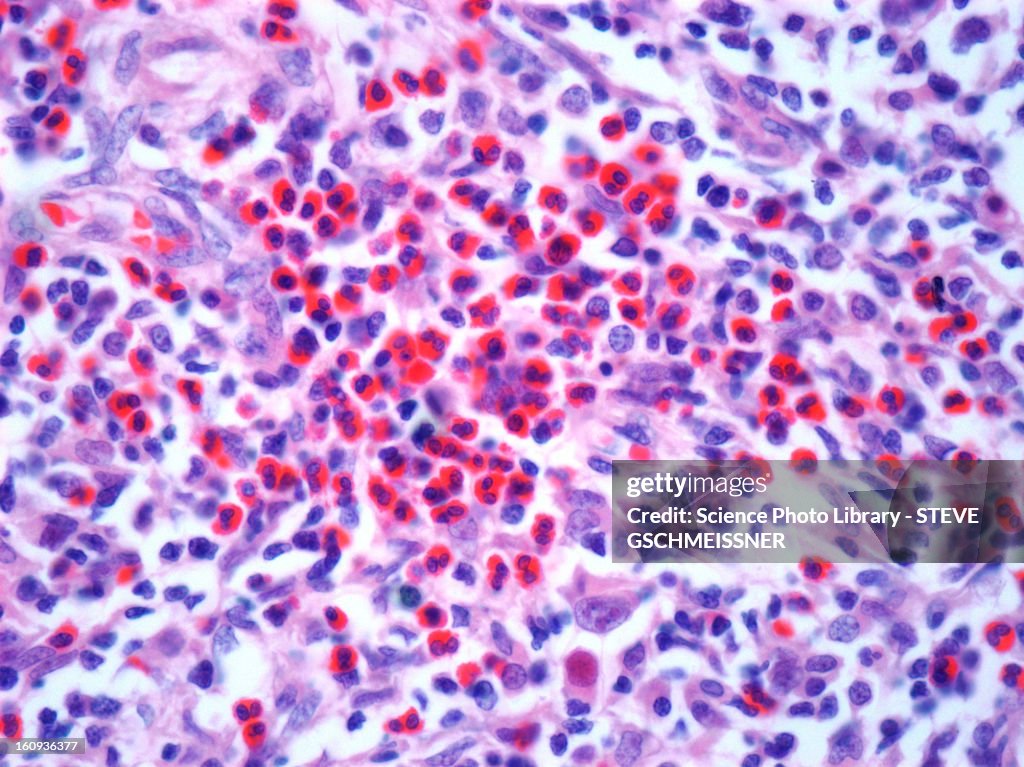 Hodgkin's lymphoma, light micrograph