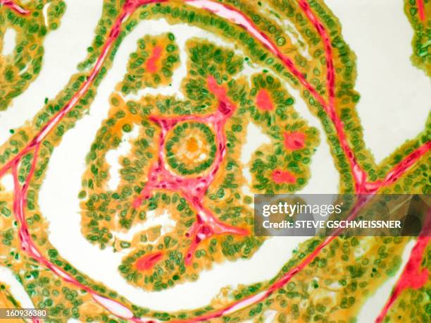 thyroid cancer, light micrograph - thyroid stock illustrations