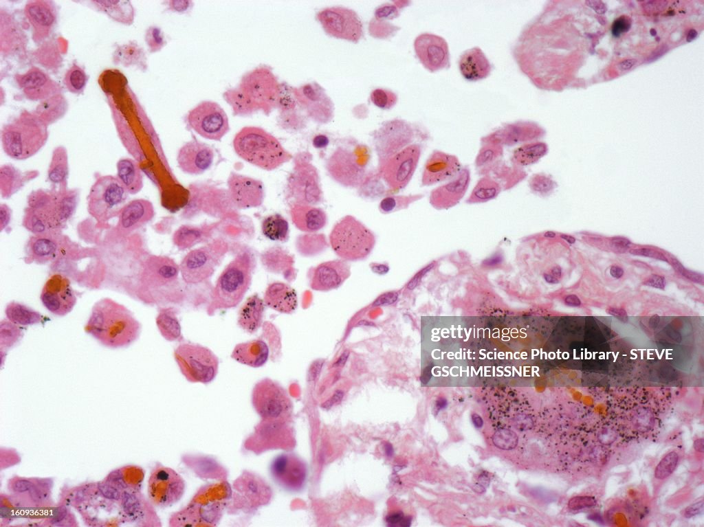 Asbestos in lung tissue, light micrograph