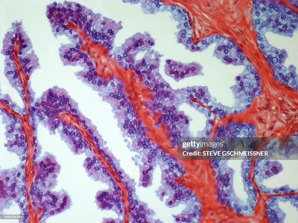 Prostate cancer, light micrograph