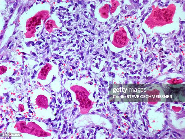 bone tumour, light micrograph - bone 幅插畫檔、美工圖案、卡通及圖標