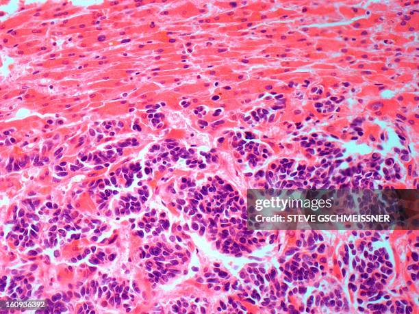 secondary liver cancer, light micrograph - 光学顕微鏡図点のイラスト素材／クリップアート素材／マンガ素材／アイコン素材