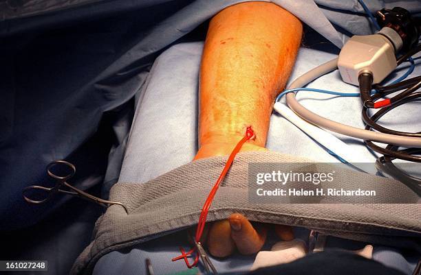 The only scar that will be left on the arm of coronary bypass patient 69 year old Donald Gutknecht will be this small incision that can be easily...
