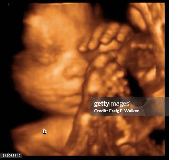 Cd09eggs_CFW-- 3D Ultrasound of one of Beth and Keith Griess' twin boys at 26 weeks. Beth is 28 weeks pregnant and one of the first pregnancies from...