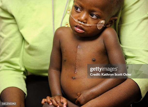 Deborah's scar from heart surgery is visible on her chest. After a grandfather in Uganda began to search for help for his granddaughter who was born...
