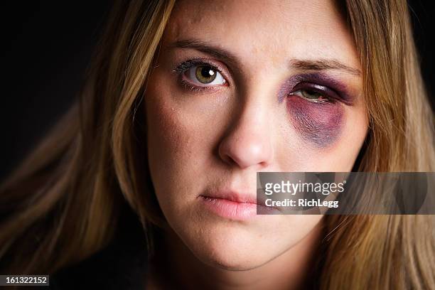 mujer con un ojo negro - bruise fotografías e imágenes de stock