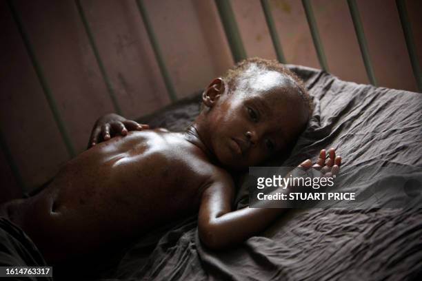 In a photograph released by the African Union-United Nations Information Support Team on August 10, 2011 a malnourished and dehydrated child lies on...