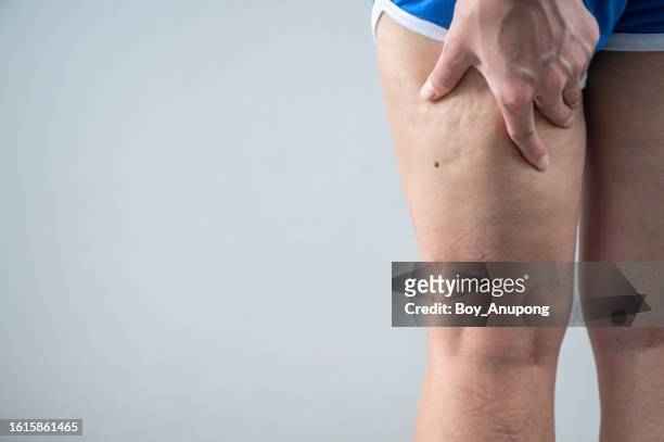 cropped shot view of woman legs with cellulite. - celulite aspecto da epiderme - fotografias e filmes do acervo