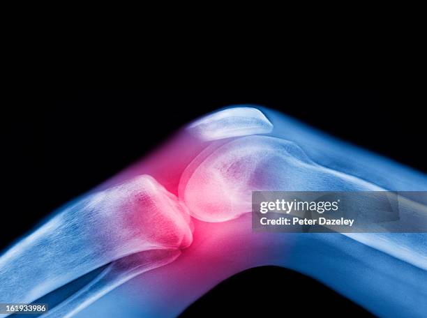 x-ray of knee with sports injury - menschliches knie stock-fotos und bilder