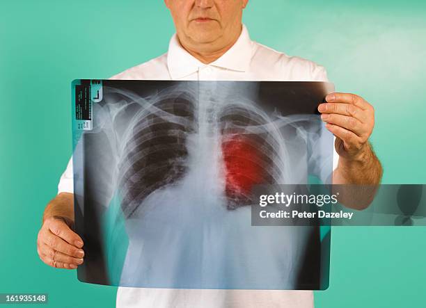 patient examining x-ray of lung cancer - emphysema stock pictures, royalty-free photos & images
