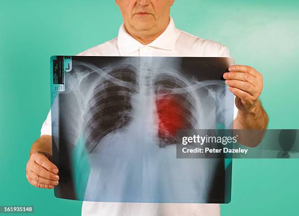 patient examining x-ray of lung cancer - smoking issues stock pictures, royalty-free photos & images