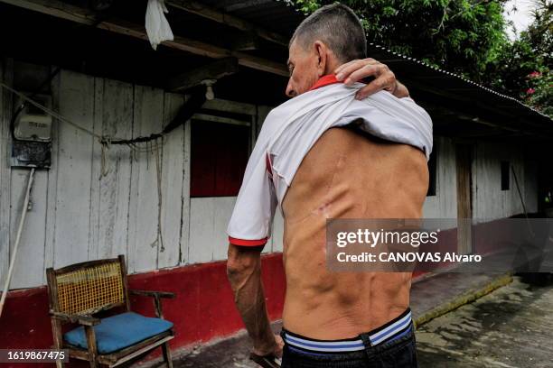 Dorodal, Colombia - June 9, 2023 - Enrique DIAS FLORES showing his scars. He miraculously survived a hippotamus attack three years ago. Hippos were...