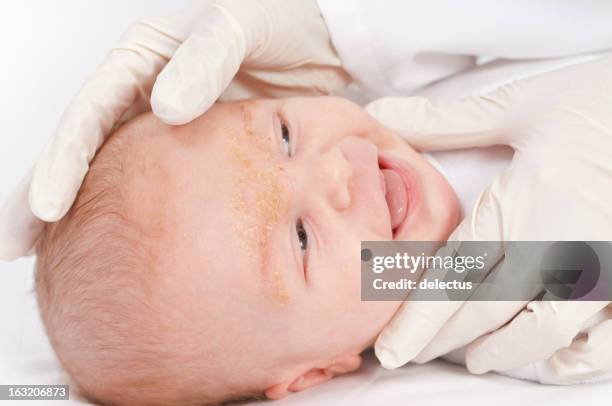 doctor inspecting a baby with seborrheic dermatitis - dermatitis stock pictures, royalty-free photos & images