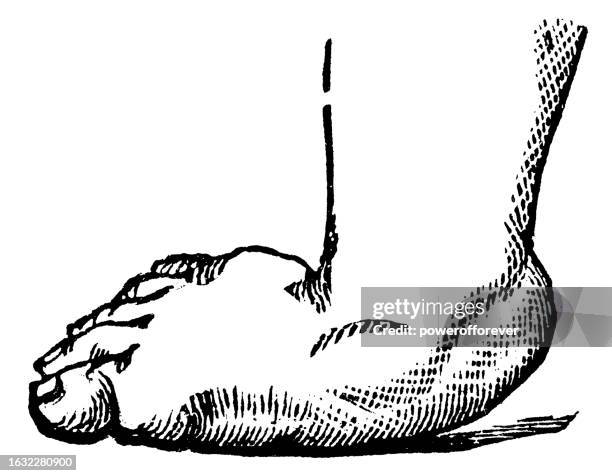 medical illustration of a human foot with talipes (clubfoot) type valgus with pes planus (fallen arch/flat feet) - 19th century - natural arch stock illustrations