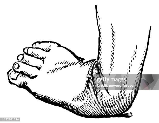 medical illustration of a human foot with talipes (clubfoot) type valgus with calcaneovalgus - 19th century - valgus stock illustrations