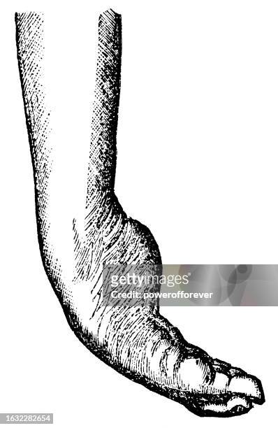 medical illustration of a human foot with talipes (clubfoot) type equinovarus (toe walking) with adductus (pigeon toe) - 19th century - touch toes stock illustrations