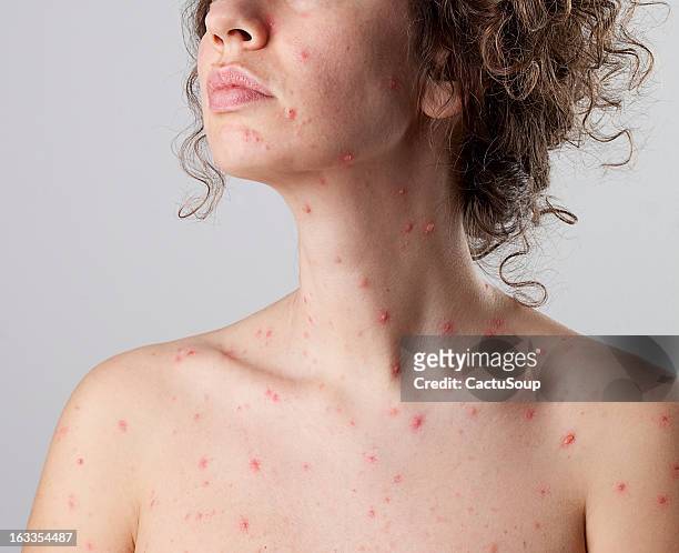 varicelle virus de la varicelle et du zona - virus pox photos et images de collection