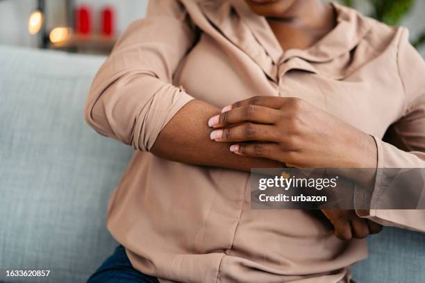 young woman scratching her skin at home - mosquito bite stock pictures, royalty-free photos & images