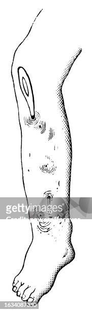 ilustraciones, imágenes clip art, dibujos animados e iconos de stock de ilustración médica de una pierna humana con necrosis - siglo 19 - fournier gangrene