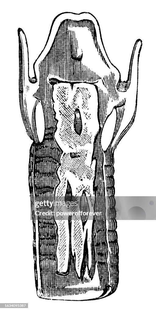 Medical Illustration of a Human Larynx with a Pseudomembrane from a Patient with Diphtheria Croup - 19th Century