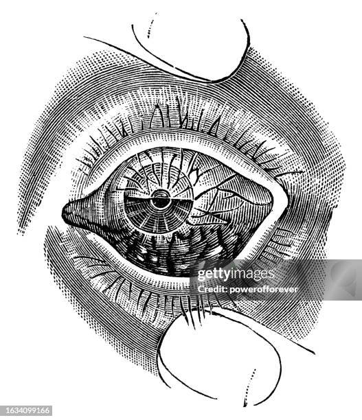 medical illustration of a human eye with trachoma - 19th century - infectious disease contact diagram stock illustrations