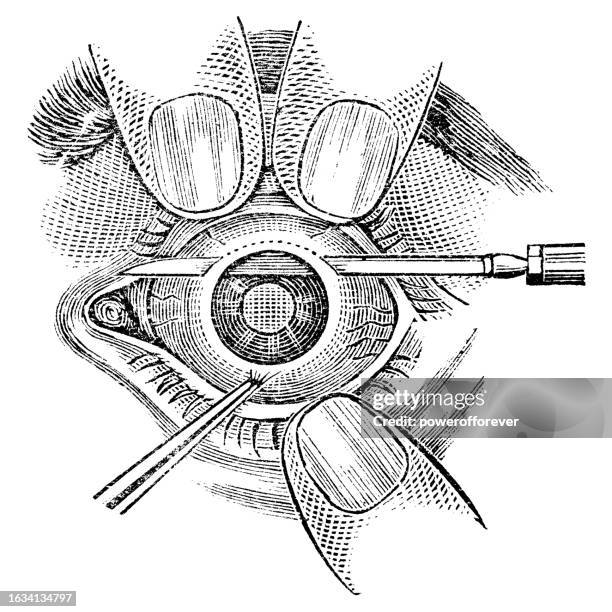 medical illustration of albrecht von graefe’s modified linear extraction cataract surgery with von graefe knife being performed on a human eye - 19th century - cataract surgery stock illustrations