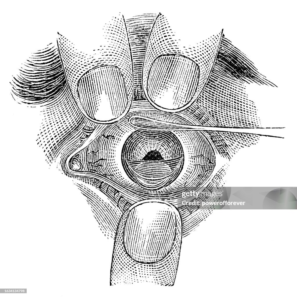 Intracapular Medical Illustration Of Intracapsular Cataract Extraction Surgery Being ...