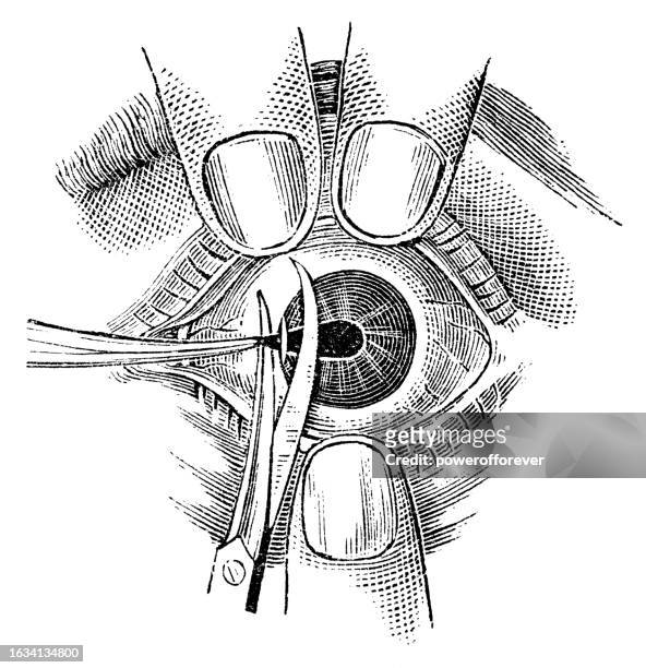 ilustrações de stock, clip art, desenhos animados e ícones de medical illustration of a surgical iridectomy being performed on a human eye - 19th century - extraction forceps