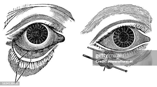 medical illustration of involutional ectropion repair surgery on a human eye with ectropion - 19th century - drooping eyelid stock illustrations