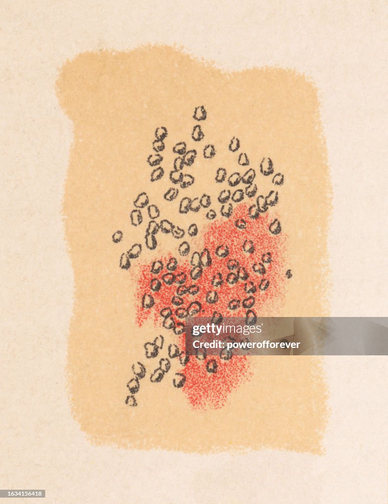 Medical Illustration of Human Skin with Atopic Dermatitis (Eczema) - 19th Century