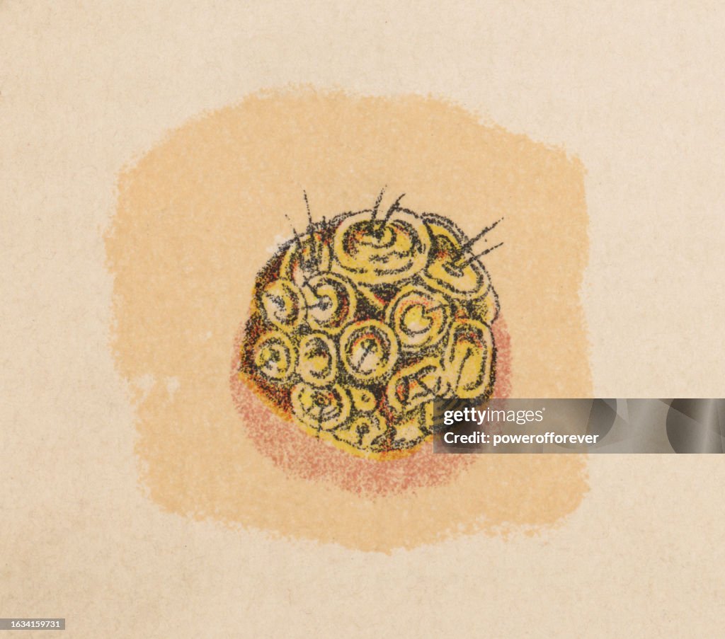 Medical Illustration Of Human Skin With Favus 19th Century High-Res ...