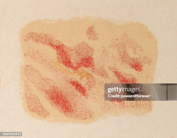 medical illustration of human skin with lichen planus - 19th century - lichen stock illustrations