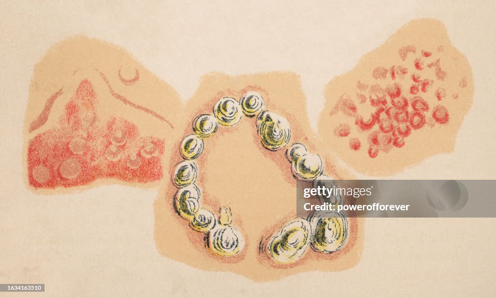 Medical Illustration of Human Skin with Uticaria (Hives), Pemphigus and Erythema Nodosum - 19th Century