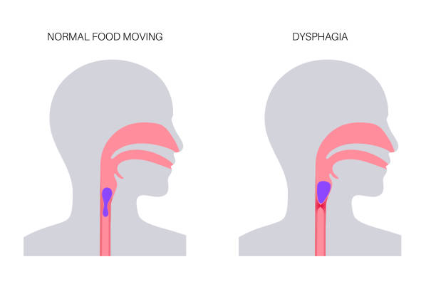 Dysphagia medical poster that explains how normal foods moves and how it moves with dysphagia