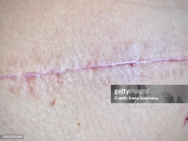 post-operative scar - medical stitches ストックフォトと画像