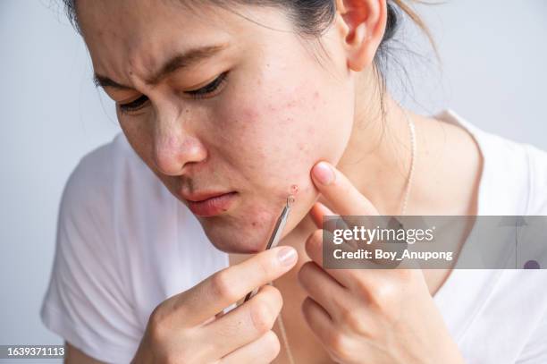 asian woman trying to use acne needle for break the surface of pore before squeeze acne out. - pores stockfoto's en -beelden