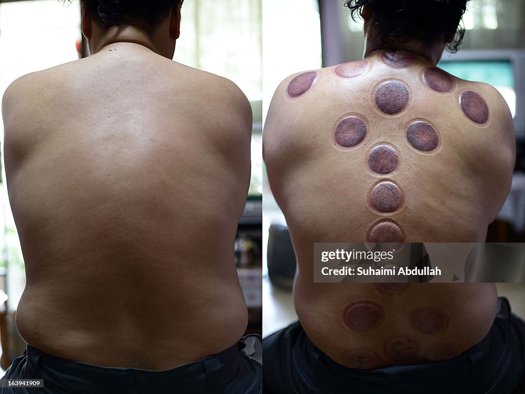 Cupping Therapy Practised In Singapore