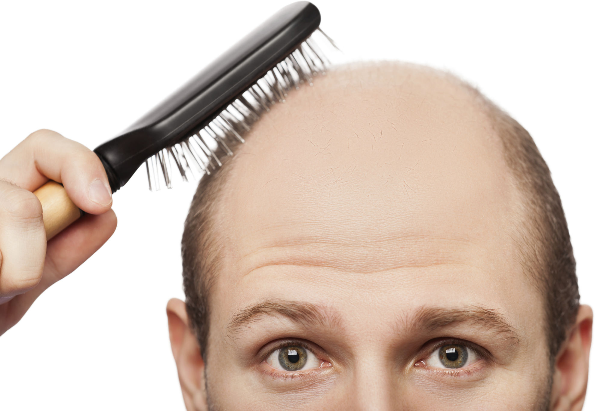 alopecia hair loss cure causes in men alopecia hair loss cure causes in men
