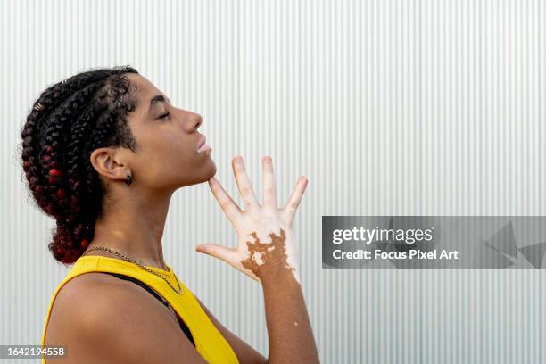 portrait and close-up of young woman with vitiligo disease with eyes closed and hands in front of head. - vitiligo stock-fotos und bilder