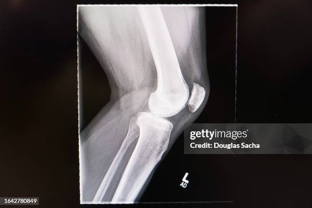 x-ray knee - human bone stock pictures, royalty-free photos & images